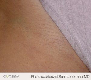 Laser Hair Removal Orange County, CA | Laser Hair Removal Near Me