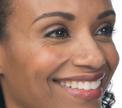 Moderate to severe crow's feet lines botox after photo