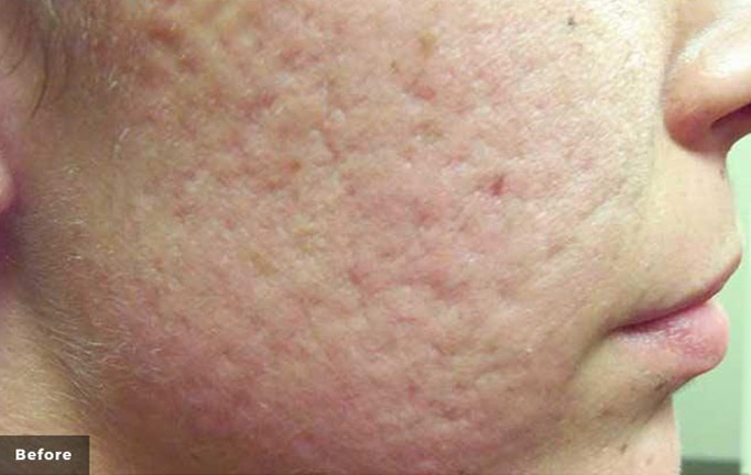 Laser acne treatment before