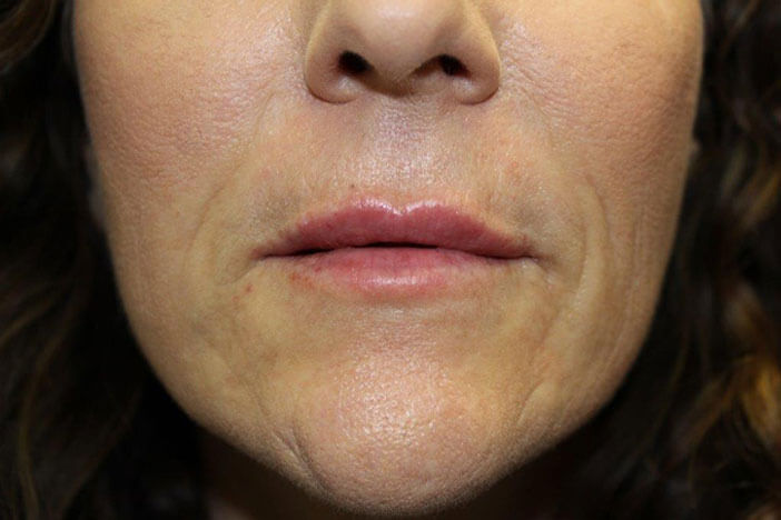 Juvederm Volbella After