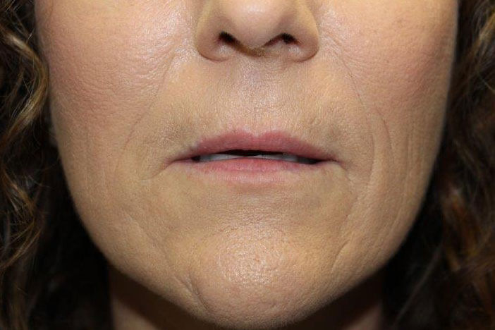 Juvederm Volbella Before