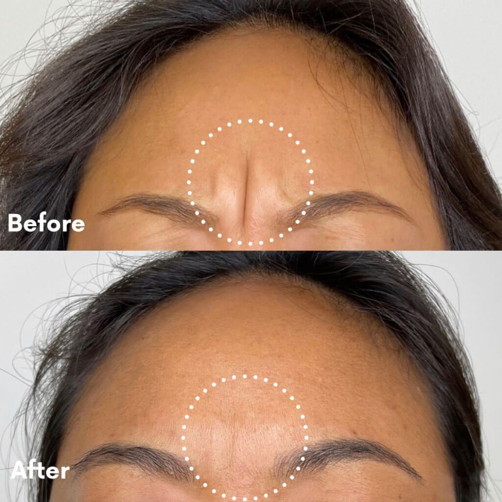 Glabellar Botox Before and After