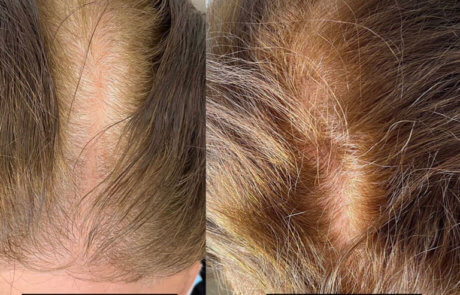 Hair Loss Treatment for Men