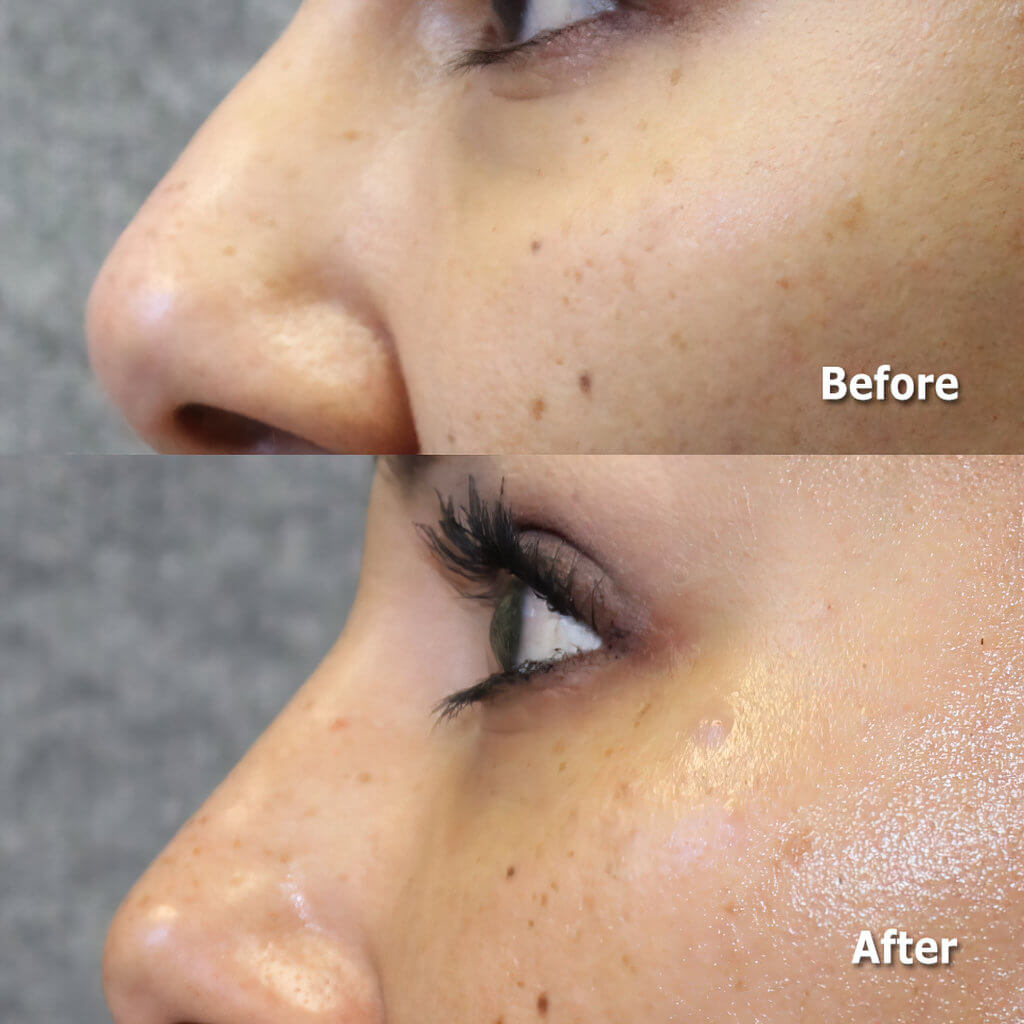 Non-surgical nose job with fillers