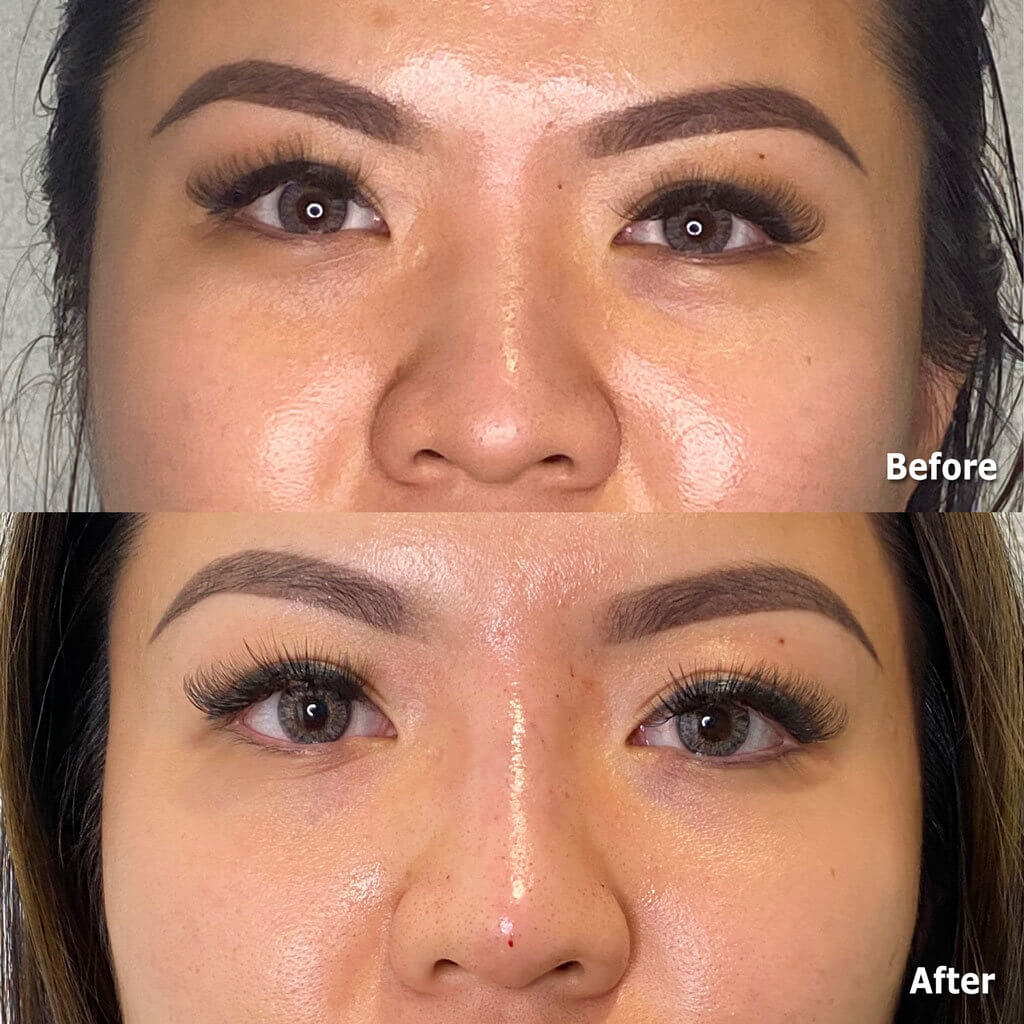 Non-surgical nose job with fillers