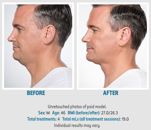 Kybella Before & After - Precision Aesthetics - Orange County, CA