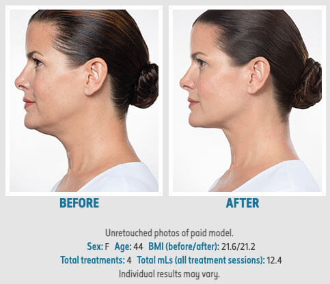 Kybella Before & After - Precision Aesthetics - Orange County, CA