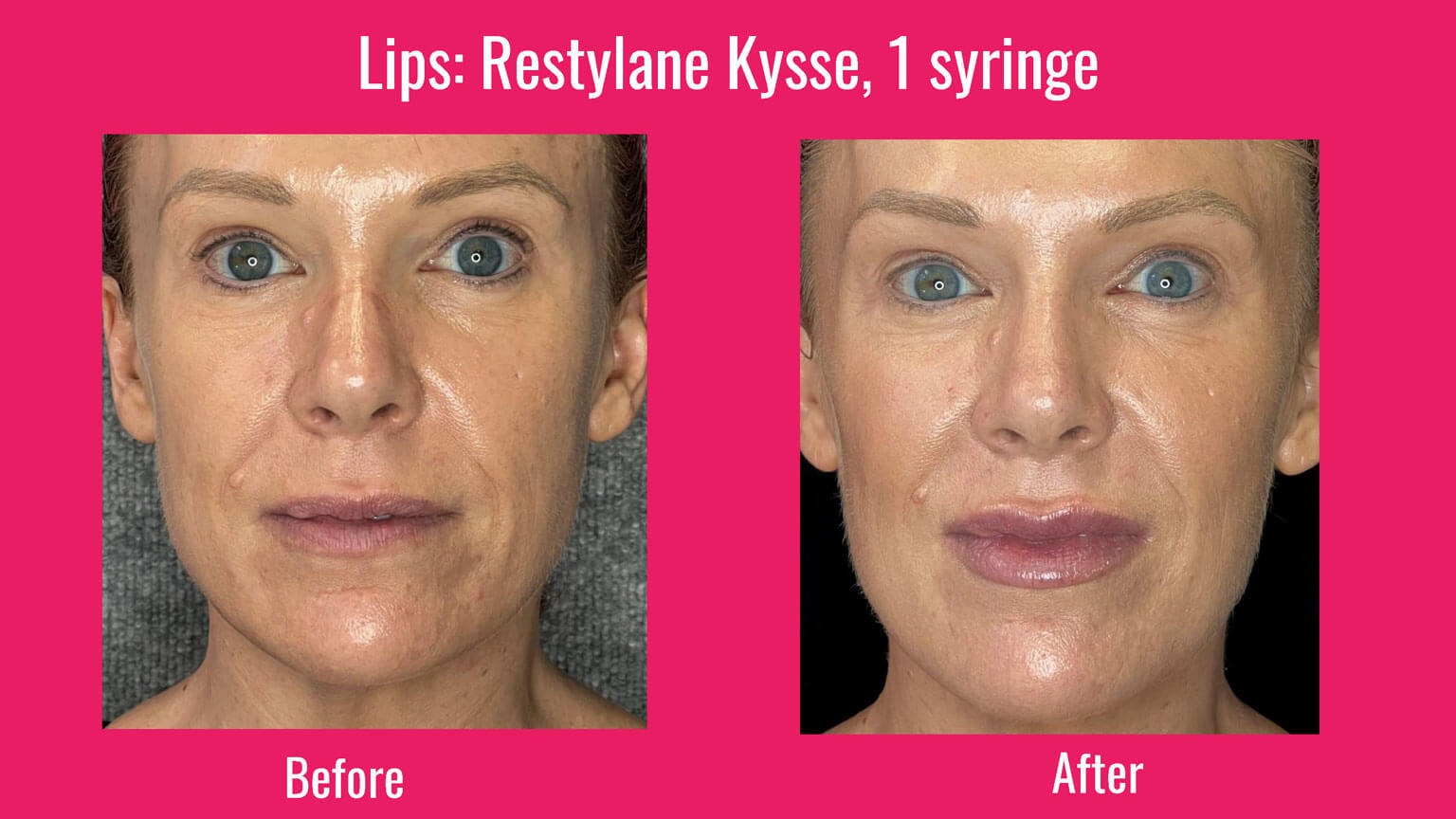 Restylane Kysse & Juvéderm Voluma before and after photos