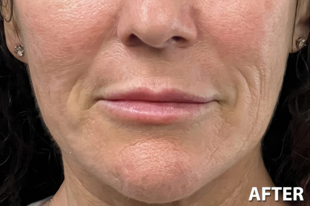 Lip Fillers Before & After - Precision Aesthetics Medical Group