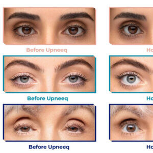 Upneeq for drooping eyelids - Precision Aesthetics