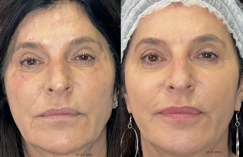 Facial Rejuvenation for Orange County, CA - Precision Aesthetics