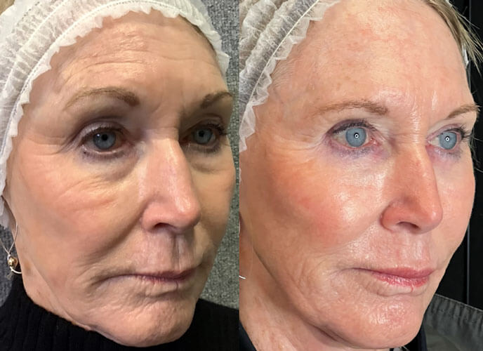Facial Rejuvenation for Orange County, CA - Precision Aesthetics