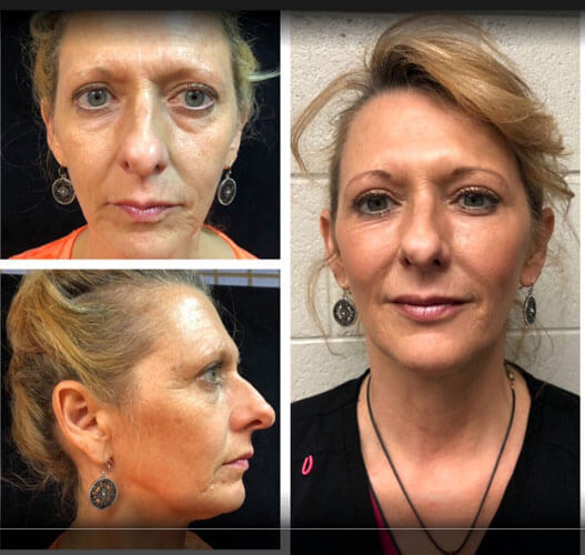 Facial Rejuvenation for Orange County, CA - Precision Aesthetics