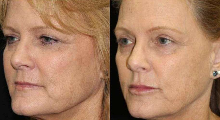 Facial Rejuvenation for Orange County, CA - Precision Aesthetics