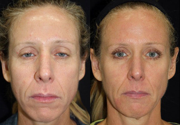 Facial Rejuvenation for Orange County, CA - Precision Aesthetics